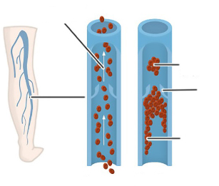indicaciones de cirugía para varices